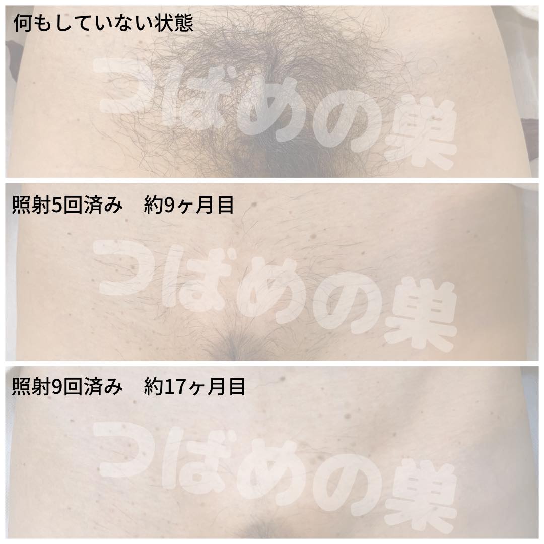 女性Vio脱毛の写真と経過の真実！何回でツルツル？後悔しない全知識