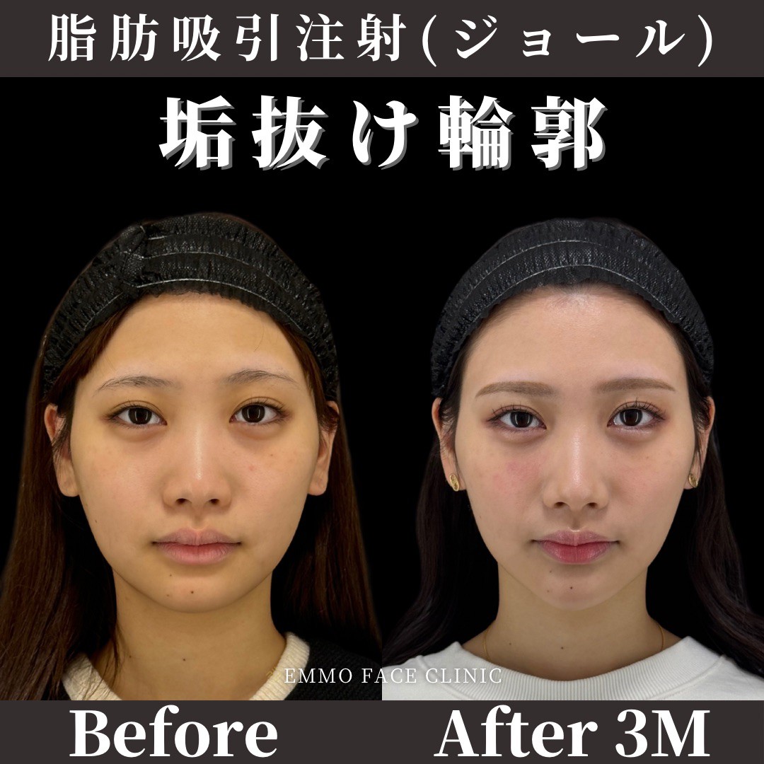 体重は減っても頬の肉が落ちない？顔痩せの決定打と美容医療の真実