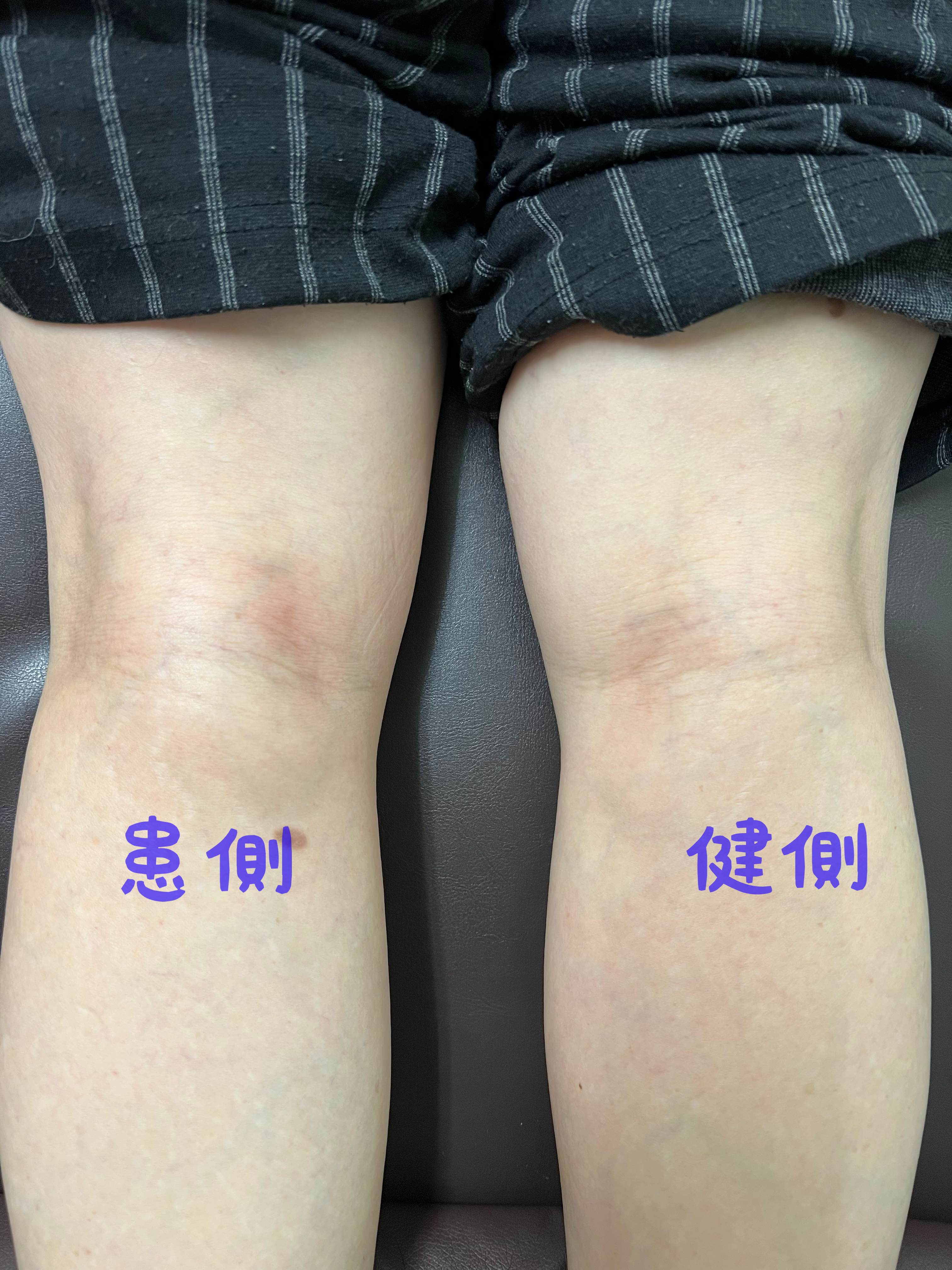 膝裏の膨らみは放置Ng？痛くないしこりの正体と正しい受診目安